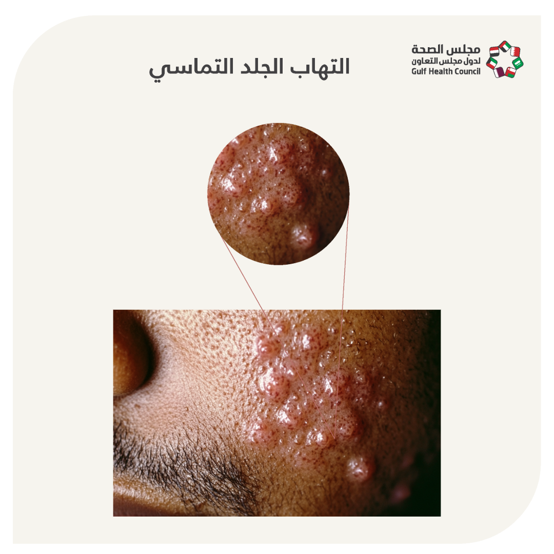 التهاب الجلد التماسي (Contact dermatitis)