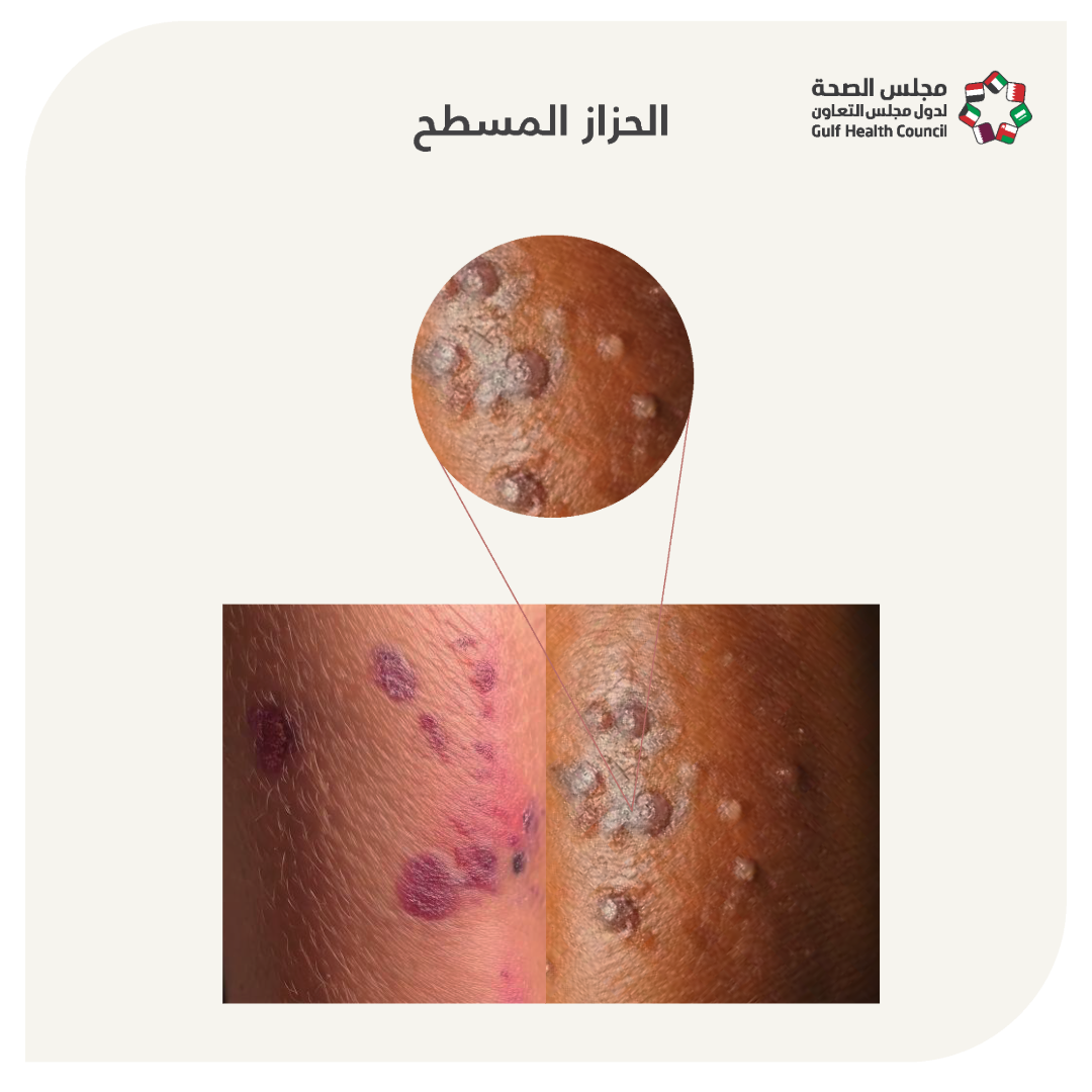الحزاز المسطح (Lichen planus)