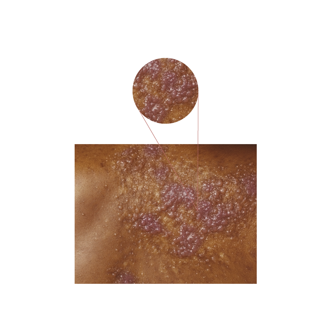 الحزام الناري (Shingles)