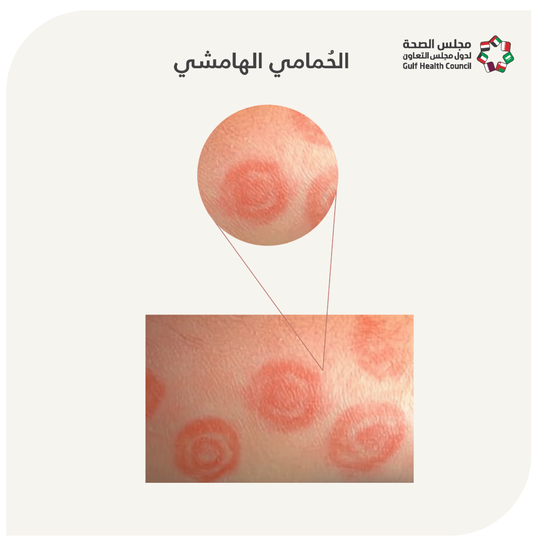 الحمامي الهامشية  (Erythema Marginatum)