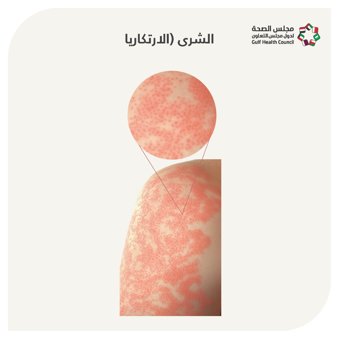 الشرى (Urticaria)