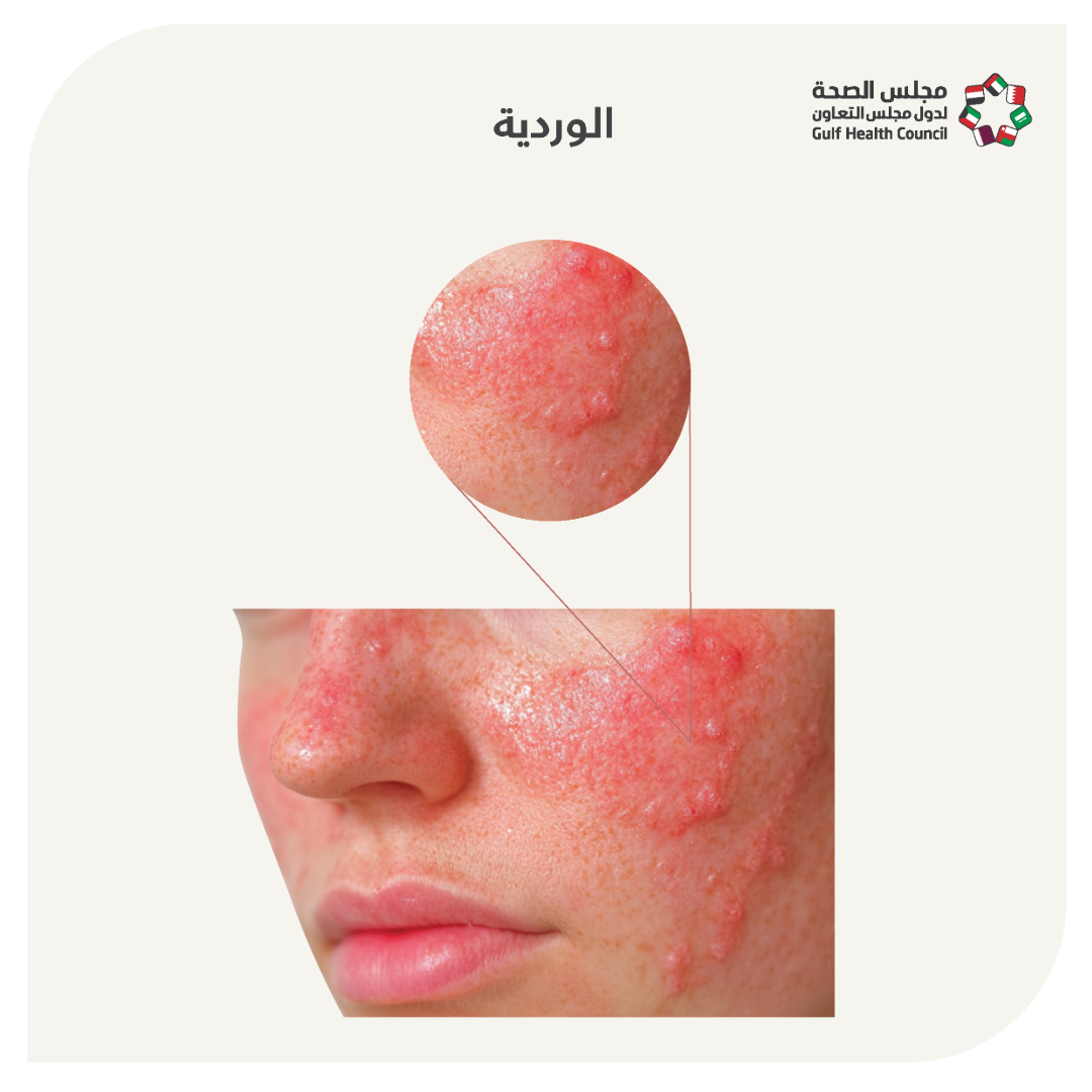 النخالة الوردية (Pityriasis Rosea)