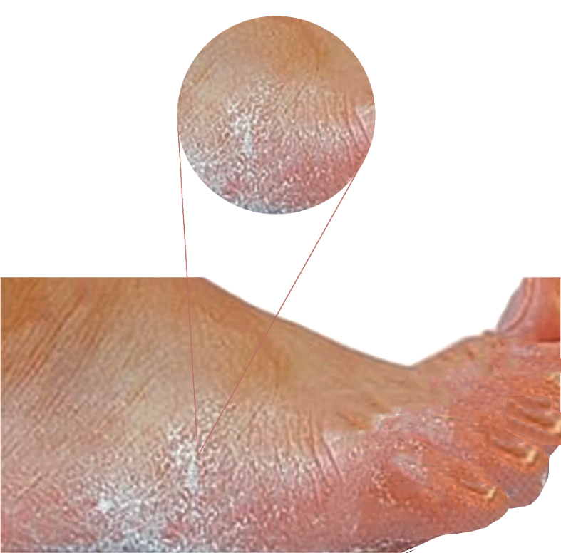 سعفة القدم (Athlete’s foot)